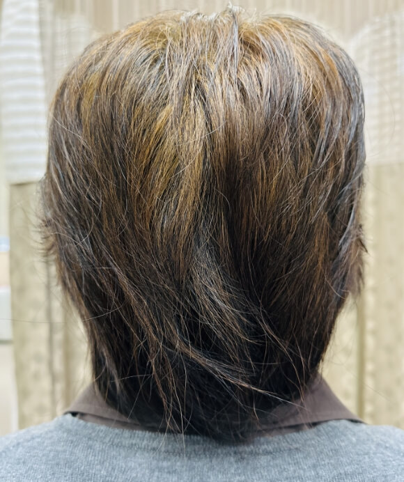 50代女性 コロナワクチン副作用脱毛症 治療後