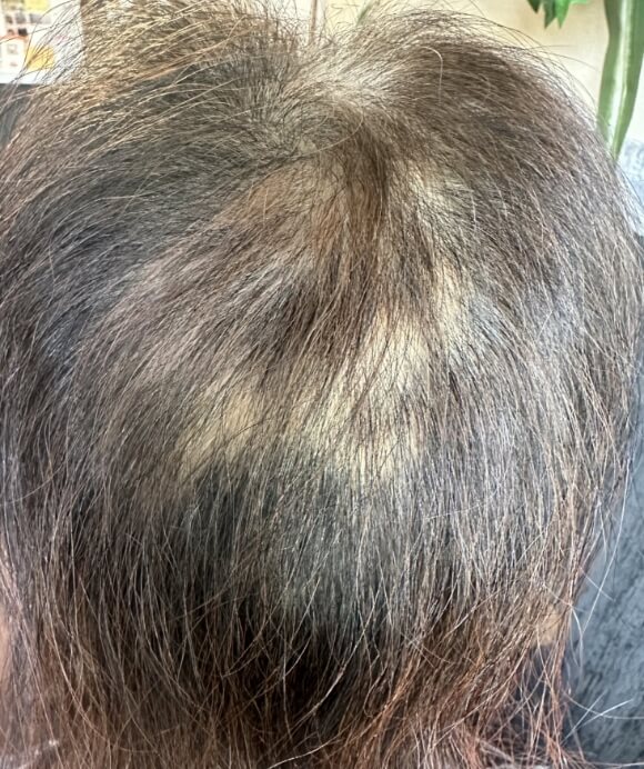 50代女性 コロナワクチン副作用脱毛症 治療前