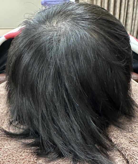 30代男性 多発性円形脱毛症 治療後