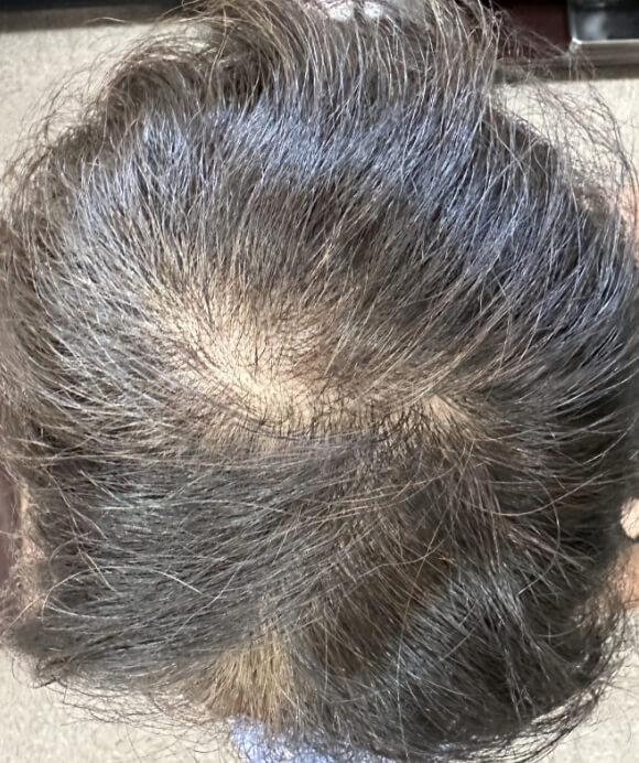 60代女性 加齢による薄毛 治療前