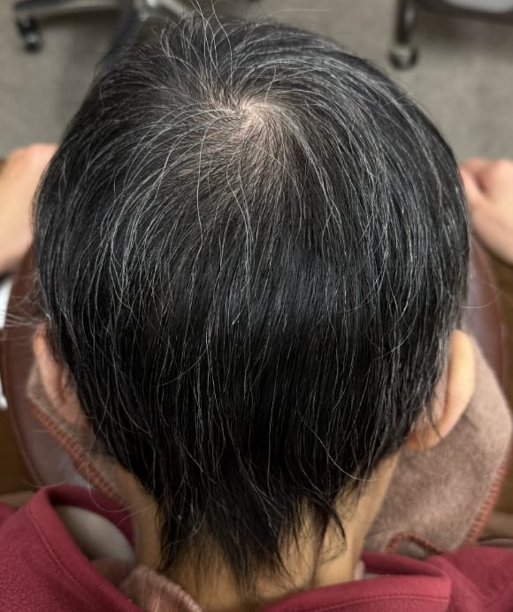汎発性脱毛症 治療後