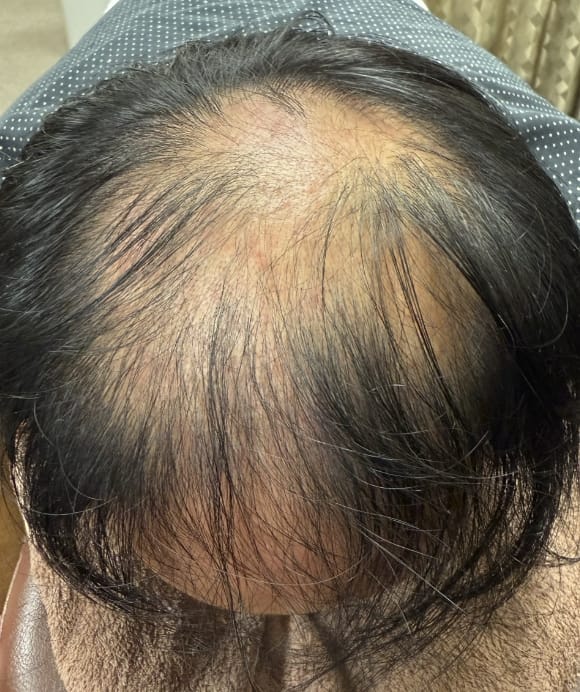 生活習慣から進行する薄毛 治療前