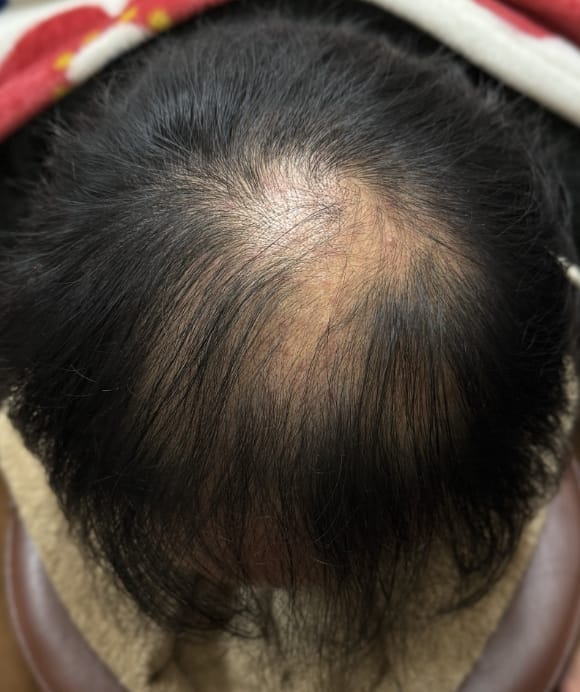 生活習慣から進行する薄毛 治療後