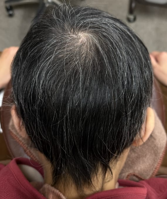 50代女性：汎発性脱毛症 施術後