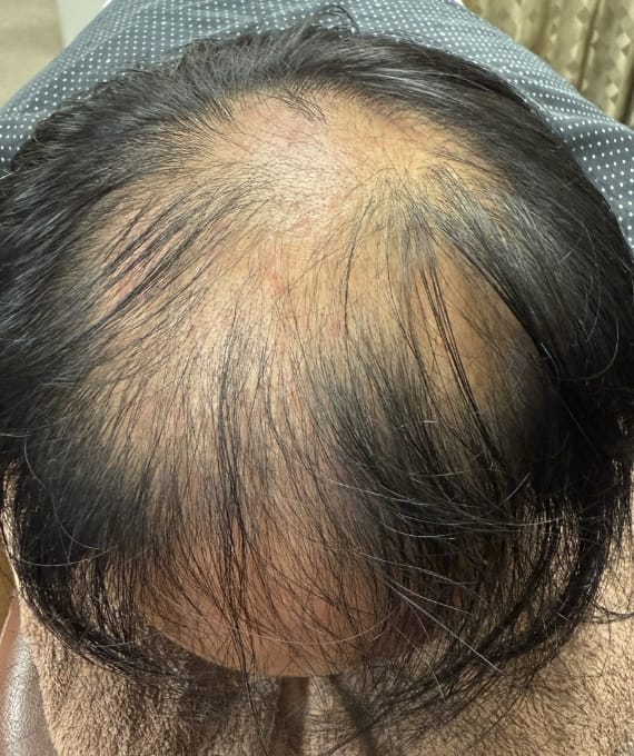 40代男性：薄毛の進行 施術前