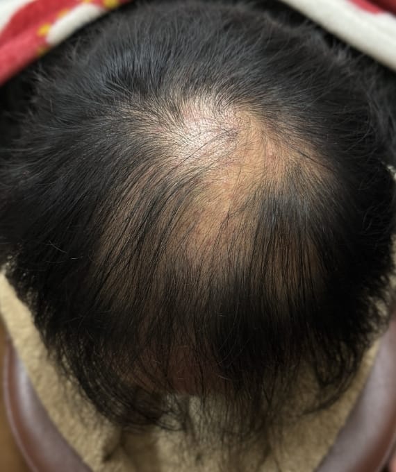 40代男性：薄毛の進行 施術後