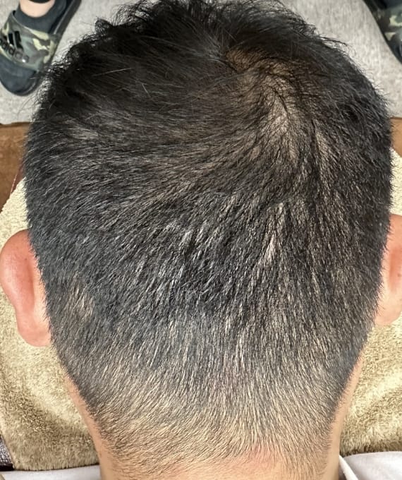 40代男性：多発性円形脱毛症 施術後